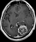 Thumbnail of Postcontrast T1-weighted magnetic resononance image of the brain of a 44-year-old man with cerebral cryptococomma in Japan, 2007, showing a rim-enhancing lobulated mass (lower right) with surrounding edema in the left occipital lobe.