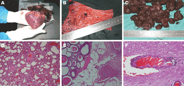 Acute form of African swine fever in wild boars. A) Petechial and larger ecchymotic hemorrhages beneath the epicardium. B) Severe hyperemia and petechial and larger ecchymotic hemorrhages in mucosa of urinary bladder. These hemorrhages are common in acute infectious fever and hemorrhagic diathesis. C) Blood-tinged colon contents with fecal balls covered by thick, blood-stained mucus. D) Congestion and fibrinous thromboses in pulmonary vessels and thickening of alveoli (hematoxylin and eosin stai