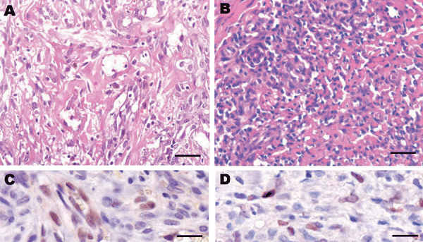 Histologic patterns of cutaneous Kaposi sarcoma (KS) associated with a human herpesvirus 8 (HHV-8) type E infection. Patient 1: A) The spindle cells were organized as bundles, forming vascular slit-like spaces containing erythrocytes. Some macrophages containing hemosiderin were observed (data not shown). Scale bar = 25 μm. C) Immunohistochemical testing showed a positive signal for HHV-8 infection (latent nuclear antigen [LANA-1]) and CD34 (data not shown). The Perls staining also gave highly p