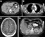 Thumbnail of A) Computed tomography (CT) scan of the abdomen showing a liver abscess adjacent to the portal vein. B) CT scan of the chest at the level of the aortic arch showing mediastinum abscesses surrounding the trachea. C) Brain magnetic resonance imaging (T1 weighted, spin echo, with contrast) showing multiple intracerebral abscesses (smooth ring-enhancing lesions with surrounding vasogenic edema). D) CT scan of the abdomen of patient from panel C, showing a left perinephric abscess and th