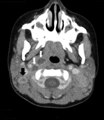 Thumbnail of Computed tomography scan of the neck of a 3-year-old girl, showing right lateral retropharyngeal abscess (white arrows) and enlarged bilateral posterior cervical lymph nodes with low attenuation of a right cervical lymph node (black arrow), consistent with atypical mycobacterium adenitis.