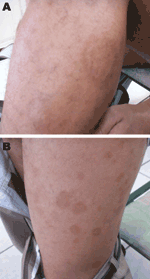 Thumbnail of Erythema migrans–like rash on the left leg of a 28-year-old patient. A) Characteristic rash of erythema migrans (annular macular lesion that is erythematous with central clearing). B) Spread of the lesions to the rest of the leg.