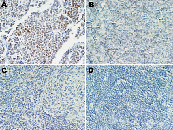 Merkel cell polyomavirus (MCPyV) large T-antigen (T-ag) expression in human tissues. A) Merkel cell carcinoma stained with CM2B4 antibody as a positive control; MCPyV T-ag was detected. B) Expression of MCPyV T-ag in small lymphocytes in an MCPyV DNA–positive angioimmunoblastic T-cell lymphoma, stained with CM2B4. C) MCPyV DNA–positive reactive lymphoid hyperplasia sample reacted with CM2B4; no T-ag was detected. D) MCPyV DNA-negative chronic lymphocytic leukemia/small lymphocytic lymphoma sampl
