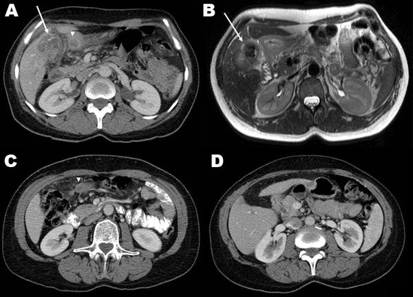 A) Contrast-enhanced computerized tomography (CT) scan showing a calcified gallbladder wall (arrow), a surrounding, calcified mass located peripherally in the liver, and an abscess in the adjacent fat tissue (arrowhead). B) T2-weighted axial magnetic resonance imaging shows multiple gallstones and a thickened gallbladder wall (arrow), inflammation and edema of the adjacent liver, fat tissue, and proximal duodenum. C) Eight weeks after cholecystectomy, contrast-enhanced CT shows a residual absces