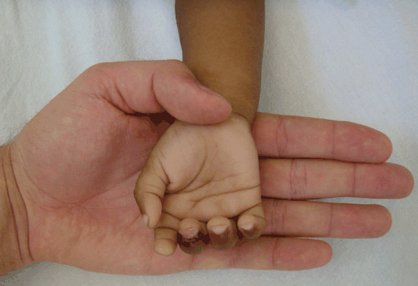 Hand of a 2-year-old child (patient no. 1) with severe anemia (hemoglobin level 3.6 g/dL), showing intense pallor, compared with the hand of a healthy physician. Photograph provided by authors.