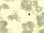 Thumbnail of Two trophozoites of Babesia spp. in 1 erythrocyte from case-patient 2 (original magnification ×1,000, May-Grünwald-Giemsa stain).