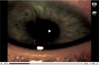 Thumbnail of . Linguatula serrata tongue worm swimming in an infected human eye.
Video Link: http://streaming.cdc.gov/vod.php?id=206de2efe9617387b685230c158245ba20110426172459732