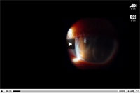 Thumbnail of Surgical removal of a Dirofilaria sp. nematode from the left eye of a 16-year-old boy, Brazil. VA, visual acuity; CF, count fingers; IOP, intraocular pressure. A portion of the material in this video was previously published in the journal Parasites and Vectors (http://www.parasitesandvectors.com/content/pdf/1756-3305-4-41.pdf).