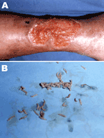 A) Crater-like ulcer ≈2.5 cm in diameter on internal surface of patient’s right leg. B) Chrysomya bezziana worms isolated from the ulcer.