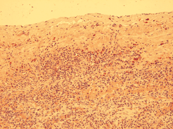 Positive immunohistochemical staining in mononuclear cells below the splenic capsule in a harbor porpoise (Phocoena phocoena) with Brucella ceti infection, Belgium, 2008. Original magnification ×200.