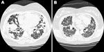 Thumbnail of Chest computed tomography scan of a 40-year-old woman with no history of systemic disease. A) Bilateral multiple lung nodules and lymphomatoid granulomatosis were diagnosed after lung biopsy. B) After rituximab treatment, the prior nodular lung lesions decreased dramatically, but newly developed interstitial ground glass opacities appeared.