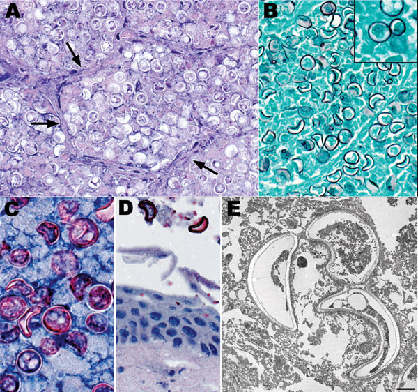 Histopathologic and electron microscopic appearance of Blastomyces dermatitidis in kinkajou (Potos flavus) tissues. A) Lung showing B. dermatitidis yeast forms filling alveolar spaces. Alveolar septa are indicated by arrows. B) Lung showing yeast forms of B. dermatitidis. Inset shows broad-based budding of a yeast form, a major diagnostic feature. C) Lung showing B. dermatitidis yeast. D) Oral mucosa showing 2 yeast forms of B. dermatitidis closely associated with the mucosal surface. E) Transmi