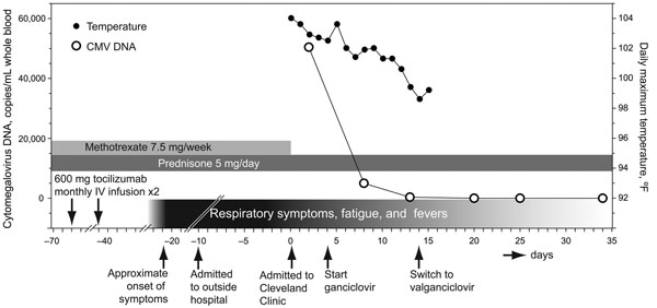 Timeline of events for a 41-year-old man with rheumatoid arthritis. CMV, cytomegalovirus; IV, intravenous.