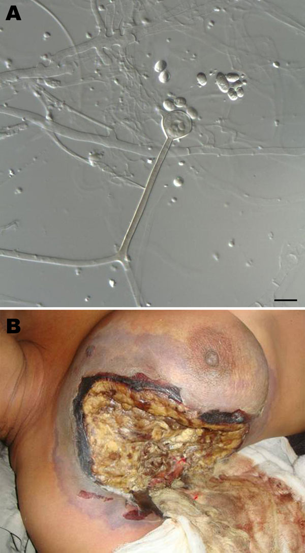 <!-- Q1 -->A) Sporangiophore (center) and sporangiospores of Apophysomyces variabilis fungi. Scale bar = 10 μm. B) Clinical manifestations in a woman infected with A. variabilis fungi in the upper part of the chest and the breast. A color version of this figure is available online (www.cdc.gov/EID/content/17/1/134-F.htm).