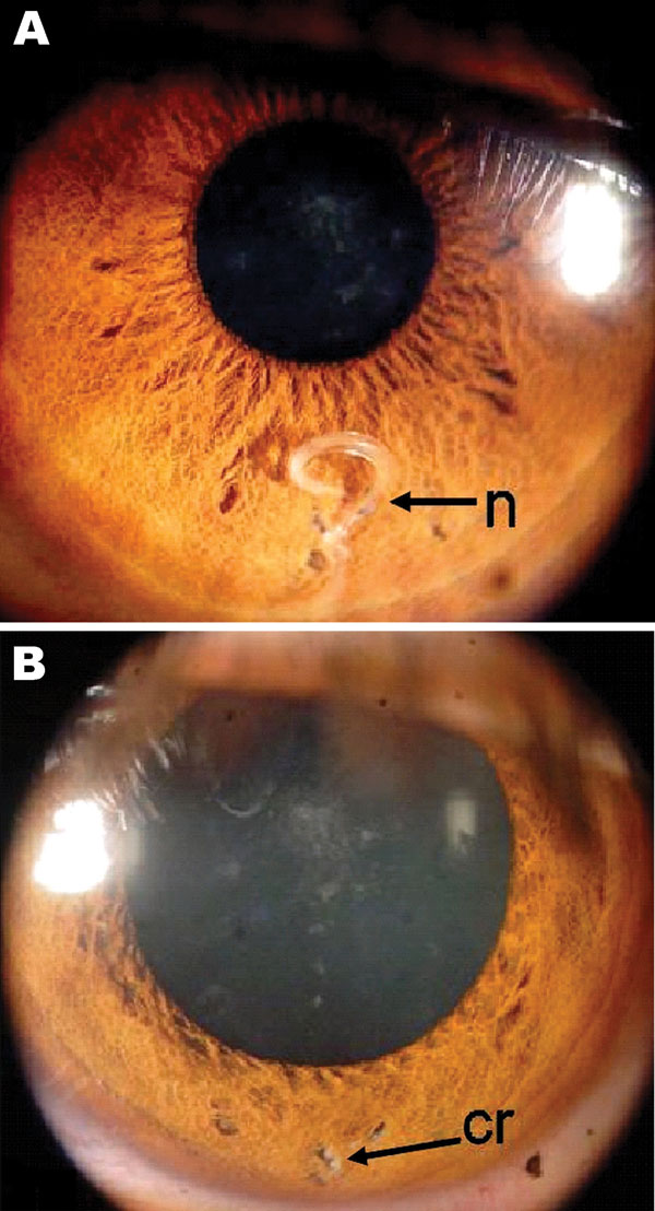 Eye of the patient, a 29-year-old man from Brazil. A) Nematode (n) between muscle fibers of the iris. B) Iris after surgery, showing a mild residual scar (cr) in the region where the nematode had been located.