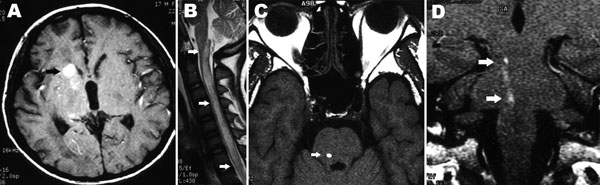 Images of the brains of patients with cerebral gnathostomiasis. A) Axial T1-weighted image showing small hemorrhage in the right basal ganglia (arrow). B) Sagittal T2-weighted images showing diffuse cord enlargement with longitudinal T2 hyperintensity (arrows). C) Axial T1-weighted image showing a hemorrhagic track in the tegmentum of the pons (arrow). D) Coronal T1-weighted postgadolinium image, showing the longitudinal extension of the same hemorrhagic track as in panel C (arrows). Images from