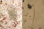 Thumbnail of Trichostrongylus colubriformis nematode isolated from feces of a 47-year-old woman, France. A) Egg (length 89 µm) isolated by using direct examination (original magnification ×200). B) Third-stage larvae (length 740 µm, 16 intestinal cells, length of distal part of the sheath &lt;40 µm) isolated by using fecal culture (original magnification ×50).