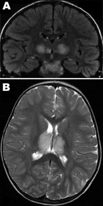 Thumbnail of A) Magnetic resonance image of brain corona of patient 1, a 6-year-old boy with acute necrotizing encephalopathy (ANE). B). Axial-weighted images of brain thalami of patient 2, a 22-month-old girl with ANE, the cousin of patient 1.