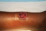 Thumbnail of Painless ulcer with raised edges corresponding to a primary yaws skin lesion on an infant case-patient’s leg, Papua New Guinea, 2009. Source of photograph: Lihir Medical Centre, Dr Oriol Mitjá.