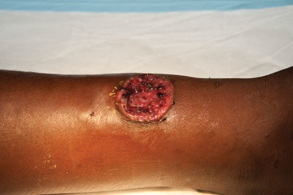 Painless ulcer with raised edges corresponding to a primary yaws skin lesion on an infant case-patient’s leg, Papua New Guinea, 2009. Source of photograph: Lihir Medical Centre, Dr Oriol Mitjá.