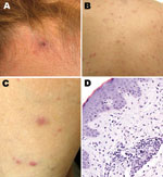 Thumbnail of Cutaneous lesions of patients with suspected and confirmed Rickettsia parkeri rickettsiosis in Argentina. A) Eschar at the nape of the neck at the site of recent tick bite. B, C) Papulovesicular rash involving the back and lower extremities. D) Histopathologic appearance of a papule biopsy specimen, showing perivascular mononuclear inflammatory cell infiltrates and edema of the adjacent superficial dermis and an intact epidermis (hematoxylin and eosin stain; original magnification ×