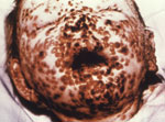 Thumbnail of One-year-old child on day 10 of a smallpox infection; his face is covered with painful lesions that are beginning to scab. Photograph courtesy of the Centers for Disease and Prevention Public Health Image Library; by Charles Farmer, Jr., 1962.