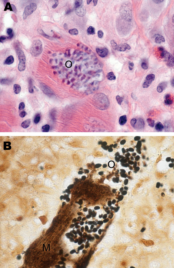 Skeletal muscle tissue samples from a 67-year-old woman with Tubulinosema sp. infection, 2009. A) Hematoxylin and eosin stain shows inflamed fibers with mononuclear infiltrate (O). B) Warthin-Starry silver stain shows abundant clusters of ovoid, basophilic organisms (O) within the muscle fibers (M). Original magnifications ×1,000.