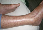 Thumbnail of Rash exhibited by patient infected with Rickettsia honei, Nepal, 2009.