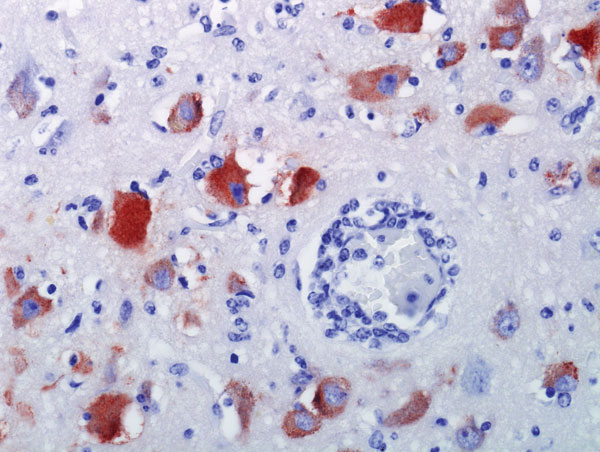 Brain specimen from killer whale (Orcinus orca) with West Nile virus infection that died at a marine park, San Antonio, Texas, USA, 2007. Neurons and glial cells demonstrate abundant intracytoplasmic West Nile viras antigen. Blood vessel demonstrates mild vasculitis and perivascular lymphocytic infiltrate. Original magnification ×200.