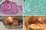 Thumbnail of Chrysosporium sp. fungal infection in eastern massasagauga rattlesnake (Sistrurus catenatus catenatus). A) Facial dermatitis and cellulitis caused by Chrysosporium sp. infection in rattlesnake from Carlyle, Illinois, USA; B) close-up showing maxillary fang destruction. C) Maxillary dermal and subcutaneous fungal granuloma (circled area). Hematoxylin and eosin stain, original magnification ×2, scale bar = 500 μm. D) Granuloma center with large numbers of fungal hyphae. Grocott methen