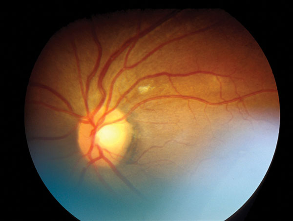 Retinal image from patient with evidence of choroidal tuberculosis.