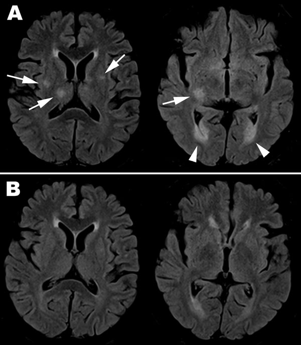 Magnetic resonance imaging with fluid-attenuated inversion recovery sequence of brain for adult patient with pandemic (H1N1) 2009 encephalitis, Taiwan. A) On day 9 after symptom onset, scattered asymmetric focal hyper signal intensities over bilateral putamen and right thalamus (arrow on the left image) and ventriculitis over bilateral occipital horns (arrow head over right image) are seen. B) By day 24, the lesions had resolved.