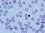 Thumbnail of Peripheral blood smear of 6-week-old infant with suspected congenital babesiosis. Thin arrows indicate Babesia spp. parasites; thick arrow shows the classic tetrad formation or Maltese cross.