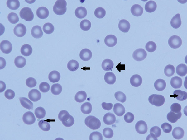 Peripheral blood smear of 6-week-old infant with suspected congenital babesiosis. Thin arrows indicate Babesia spp. parasites; thick arrow shows the classic tetrad formation or Maltese cross.
