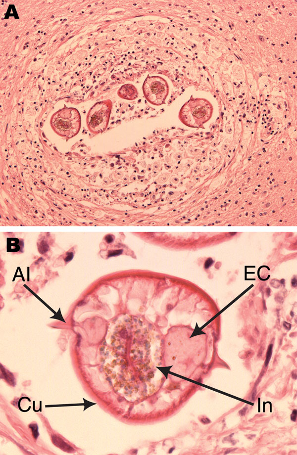 Baylisascaris procyonis infection in the frontal cerebral lobe white matter. A) Larval nematode seen in multiple transverse sections, surrounded by mild chronic inflammation and reactive changes. Hematoxylin and eosin stain; original magnification ×10. B) Morphologic features of the larvae included maximum diameter of 65 μm; thin, striated cuticle (Cu); single paired lateral alae (Al); and paired excretory columns (EC) that were smaller in diameter than the central intestine (In). Hematoxylin an
