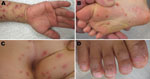 Thumbnail of Typical clinical manifestations of hand, foot, and mouth disease associated with coxsackievirus CVA6 in Shizuoka, Japan, June–July, 2011. A) Hand and arm of a 2.5-year-old boy; B) foot and C) buttocks of a 6-year-old boy; D) nail matrix of a 20-month old boy.