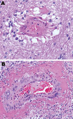 Thumbnail of Brain vasculitis in horse experimentally infected with Hendra virus, Australia. A) Parenchyma and B) ovary of horse 2. Original magnification ×200.