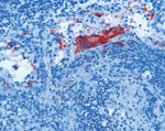 Thumbnail of Lymphadenitis with syncytial cell formation in horse 2 experimentally infected with Hendra virus (HeV), Australia. Immunohistochemical staining of HeV N protein showing presence of antigen in red. Original magnification ×200.