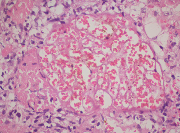 Renal biopsy sample showing patchy cortical necrosis, hematoxylin and eosin staining, Ahmedabad, India, 2010–2011 Original magnification ×400.