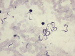Thumbnail of Thick film using Field’s stain showing trypanosomes under ×400 magnification. Motile trypanosomes are shown in the Video.