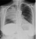 Thumbnail of Chest radiograph demonstrating right-upper lobe consolidation in a 67-year-old woman with Legionella pneumophila serotype 1 pneumonia.