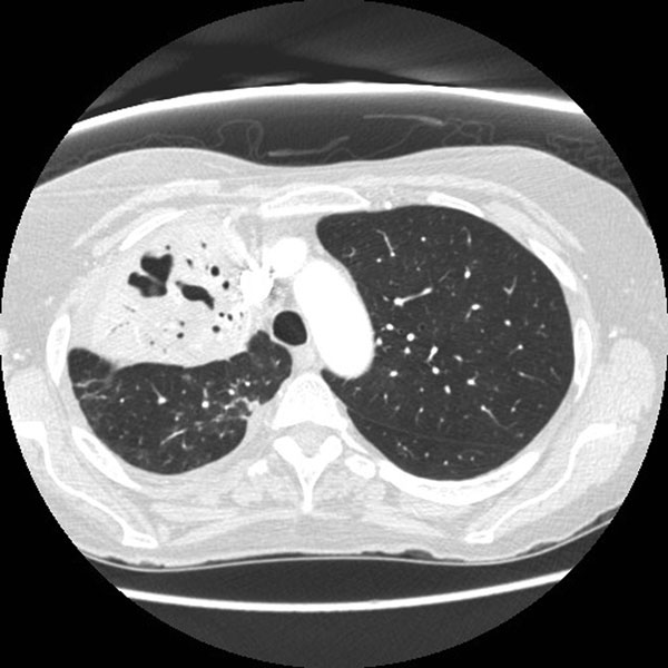 Results of repeat computed tomographic scan in a 67-year-old woman with Legionella pneumophila serotype 1 pneumonia 2 months after hospital admission. The scan shows reduction in the amount of consolidation and evolution of the lung cavity.