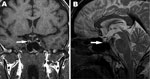 Thumbnail of Magnetic resonance images showing hemorrhage of the pituitary gland and pituitary atrophy as indicated by arrows. A) T1-weighted coronal image shows high signal intensity on the right side of the adenohypophysis consistent with hemorrhage. B) T2-weighted sagittal image shows decreased pituitary gland height and heterogenous low signal intensity of the central adenohypophysis due to hemorrhagic infarction.