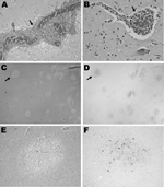 Thumbnail of Histopathologic features for patient 12 in a study of children with eastern equine encephalitis (EEE), Massachusetts and New Hampshire, 1970–2010. The postmortem samples of central nervous system tissue were obtained 10 days after the onset of symptoms. A) Hematoxylin and eosin (H&amp;E)–stained section of temporal lobe, showing meningeal inflammation (arrow) (magnification ×200). B) H&amp;E-stained section of midbrain, showing perivascular inflammation (arrow) (magnification ×400).