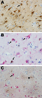 Thumbnail of Eastern equine encephalitis virus (EEEV) colocalized with neurons in patient 12 in a study of children with eastern equine encephalitis (EEE), Massachusetts and New Hampshire, 1970–2010. A) Immunohistochemistry, using EEEV immune ascites, of the entorhinal temporal cortex, demonstrating EEEV-infected neurons (arrow) (magnification ×400). B) Dual immunohistochemistry with EEE immune ascites (red stain) and a mouse monoclonal anti–neuronal nuclei (NeuN) antibody (brown stain) demonstr