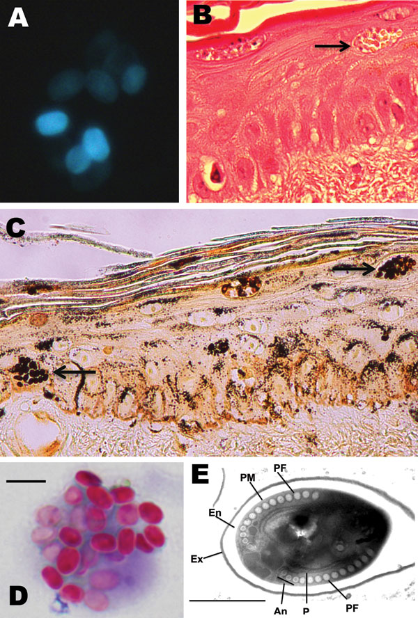 Microsporidium detected in clinical specimens from a stem cell transplant patient who had undergone substantial immunosuppression. A) Calcofluor white–stained ascitic fluid (original magnification ×500). B) Hematoxylin and eosin–stained skin biopsy sample (original magnification ×400). The arrow indicates clusters of spores. C) Warthin-Starry–stained skin biopsy sample (original magnification ×400). The arrows indicate clusters of spores. D) Modified trichrome–stained material from bronchoalveol