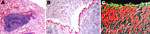 Thumbnail of Micrographs of a section of lung from a 2-year-old ferret that died of acute dyspnea. A) Image shows moderate bronchointerstitial pneumonia with severe hyperplasia of bronchiole-associated lymphoid tissue around a narrowed airway lumen; magnification ×4. B) Immunohistochemical analysis conducted with antibodies against mycoplasmas demonstrates intense labeling along the apical border of the ciliated respiratory epithelium; magnification ×40. C) Confocal scanning laser microscopy con