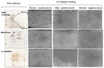 Thumbnail of Two-dimensional (2-D) gel electrophoresis with silver stain results (on left) and Western blot results (on right) for 3 serum samples from patients who had visited Laos. The proteins were resolved by using 10% sodium dodecyl sulfate polyacrylamide gel electrophoresis (Protean II xi chamber; Bio-Rad, Hercules, CA, USA). After migration, the gels were processed either by a silver-staining method compatible with mass spectrometry (4) or by transfer onto nitrocellulose membranes in a se