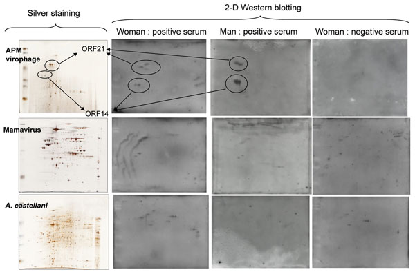 Two-dimensional (2-D) gel electrophoresis with silver stain results (on left) and Western blot results (on right) for 3 serum samples from patients who had visited Laos. The proteins were resolved by using 10% sodium dodecyl sulfate polyacrylamide gel electrophoresis (Protean II xi chamber; Bio-Rad, Hercules, CA, USA). After migration, the gels were processed either by a silver-staining method compatible with mass spectrometry (4) or by transfer onto nitrocellulose membranes in a semidry blottin