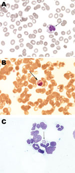 Thumbnail of Histopathology slides from 36-year-old woman with human granulocytic anaplasmosis, Slovenia, 2010. Peripheral blood smear (A, B); bone marrow smear (C). Modified Giemsa staining, original magnification ×1,000. Morulae (clusters of Anaplasma phagocytophilum in granulocytic leukocytes) are indicated by arrows. In Europe, morulae have been reported in only 1 patient (6), but they are a relatively common observation in the United States, associated predominately with severe cases of hum